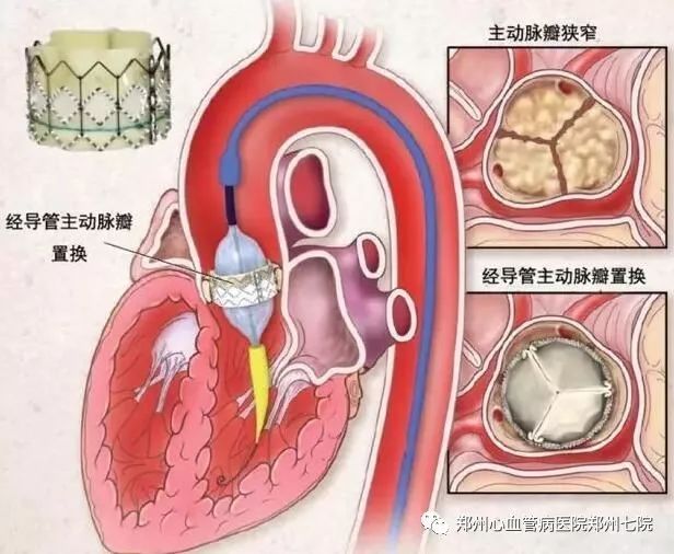 心脏换瓣不用开刀——tavr论坛侧记