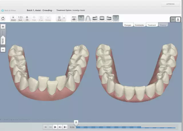 利用软件,在牙齿3d模型上模拟牙齿从原始情况到最终期望效果的正畸