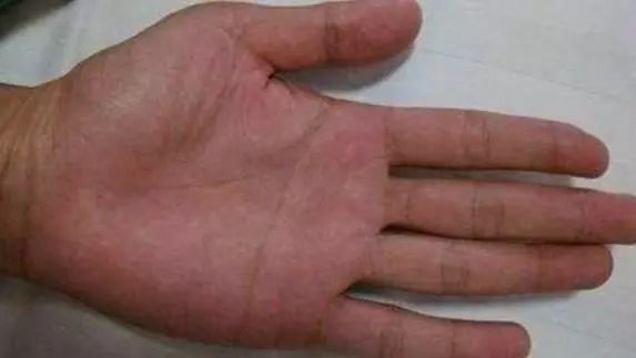 手指按压后变成苍白色,抬手后恢复正常,与正常人不同的手掌,称为肝掌