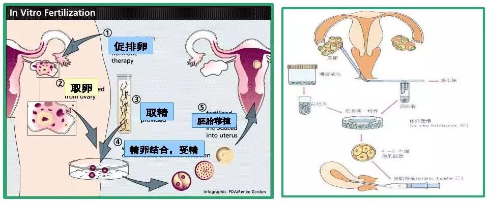 试管婴儿知识,你了解多少?