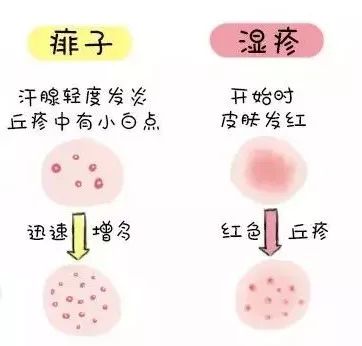 湿疹还是痱子?看完这篇你就分得清了.