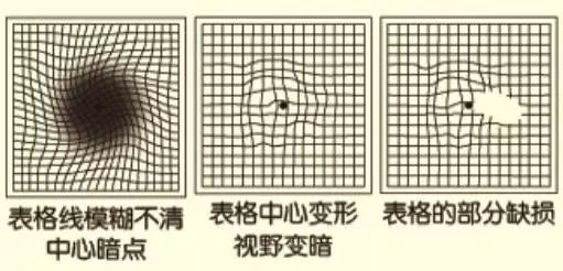 黄斑变性症状