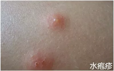 虫咬性皮炎是夏季发病率较高的皮肤病,主要是由于蚊,蠓(小咬),蚂蚁