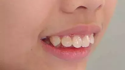 龅牙  