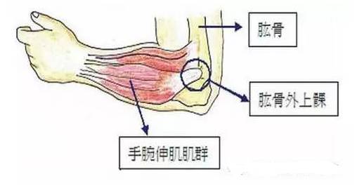 针刀治疗点: 1,t5-6 棘突旁左侧 2,c 7横突尖上方筋结点,左侧 3,锁骨