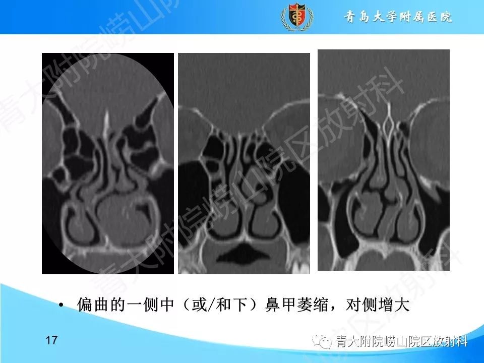 常见的鼻中隔学问也是如此之深