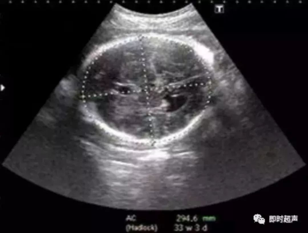 病例7-44 胎儿水肿综合征-超声读片-医学