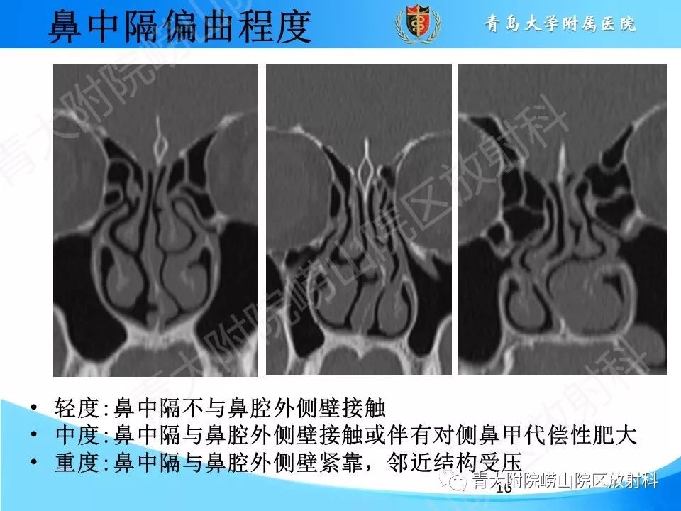 常见的鼻中隔学问也是如此之深