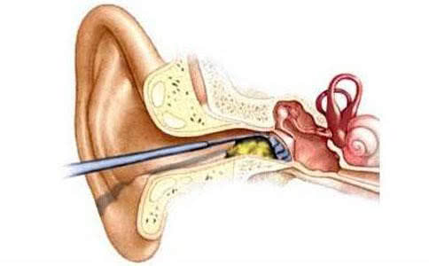 耳屎需不需要定期手动清理呢