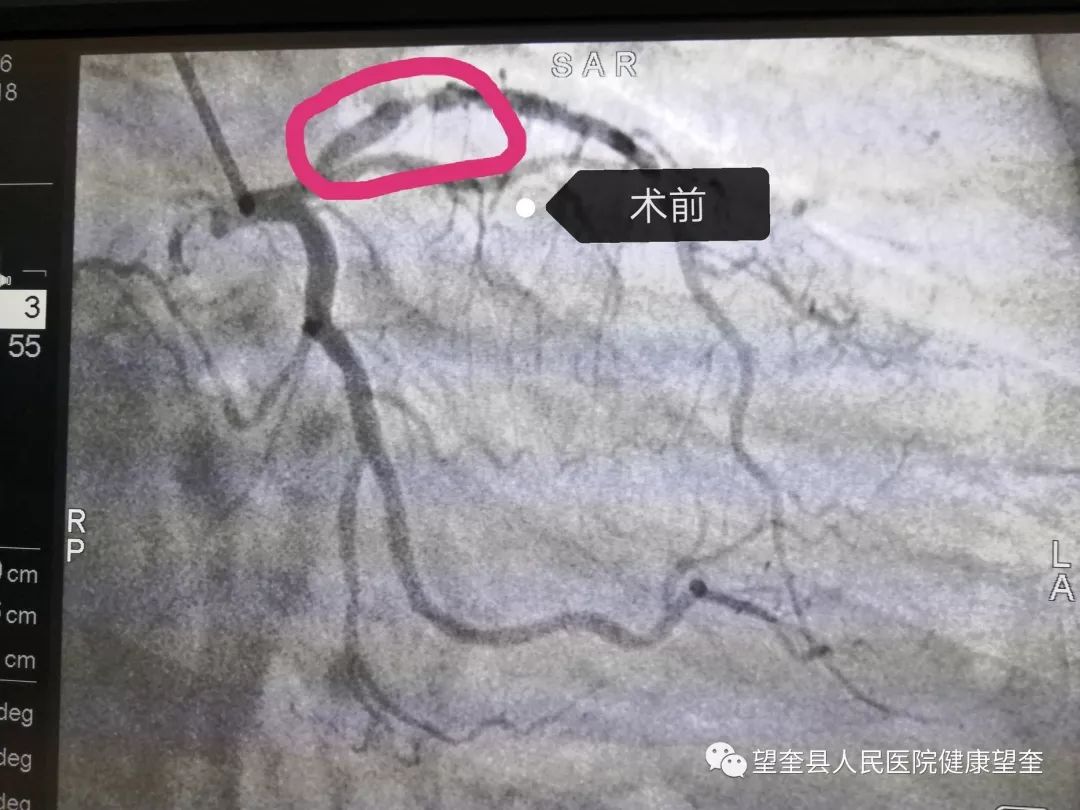 左前降支近段重度狭窄冠脉支架植入术后,冠脉狭窄被解决今日,郭俊杰