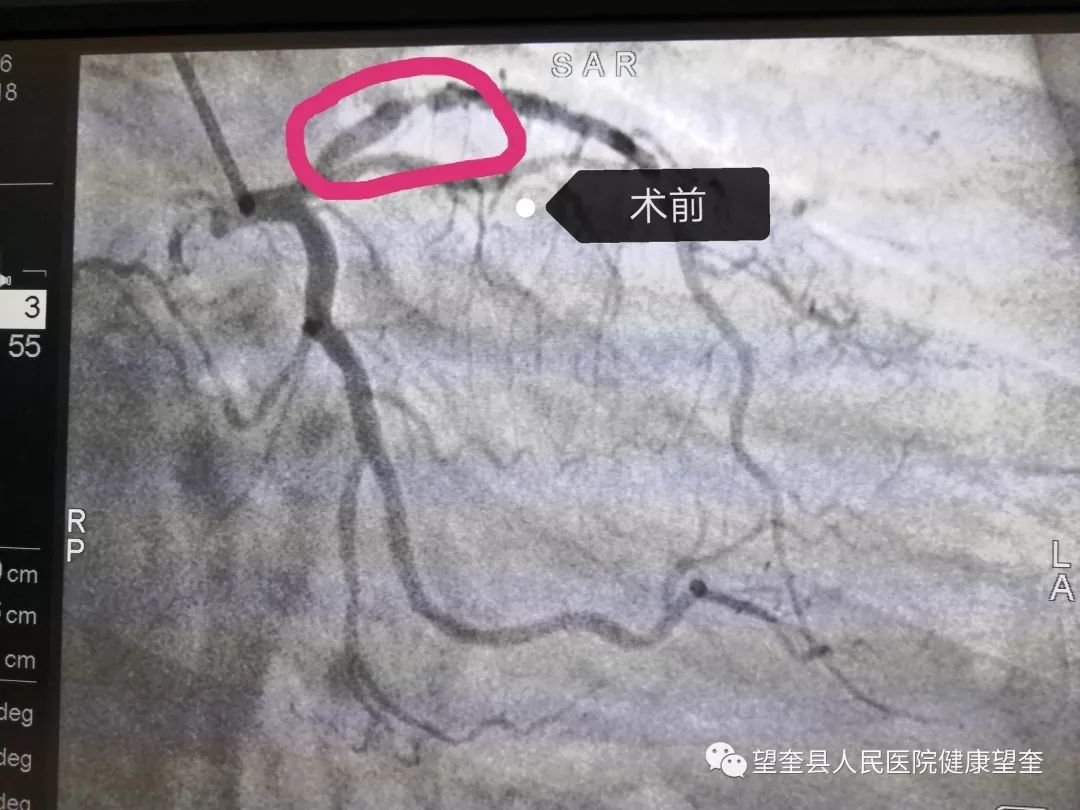 术前右侧冠状动脉重度狭窄