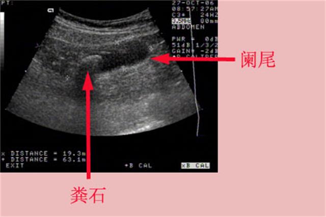 阑尾炎不需要做手术了您知道吗