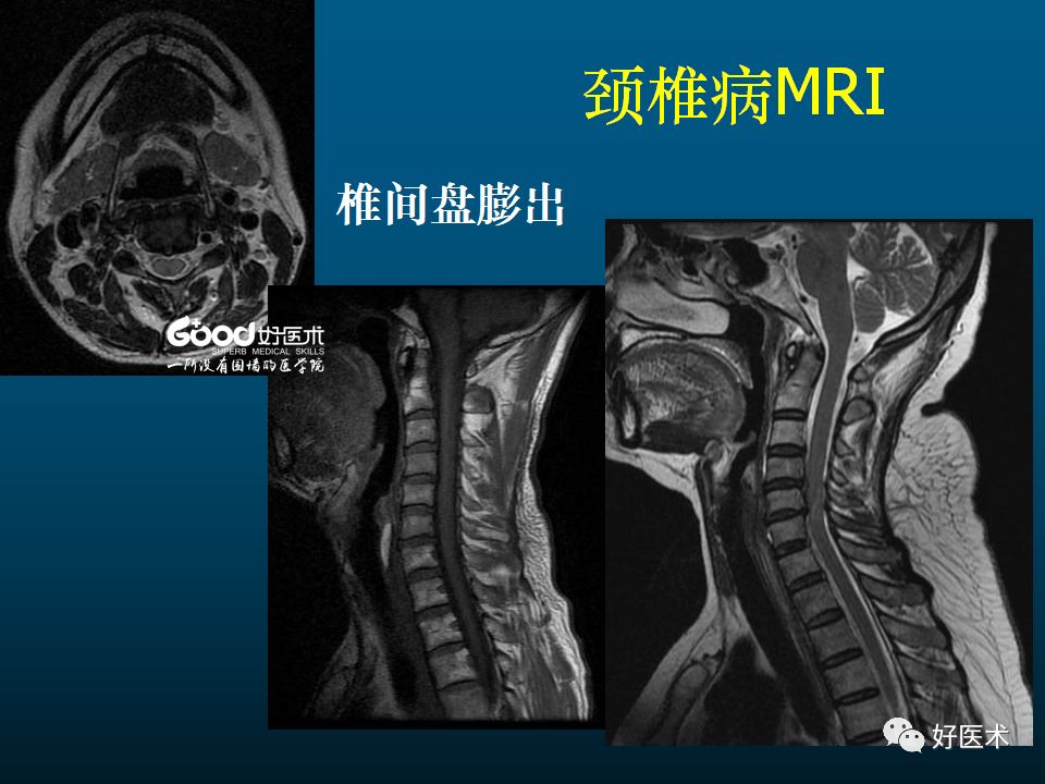 颈椎病的mri诊断技巧!