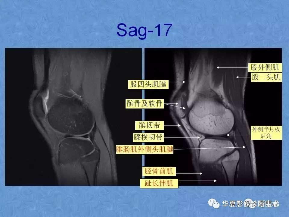 膝关节高清图