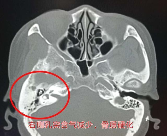 正常人的中耳乳突,含有气体,骨质正常,一般双侧对称—我们看个发病