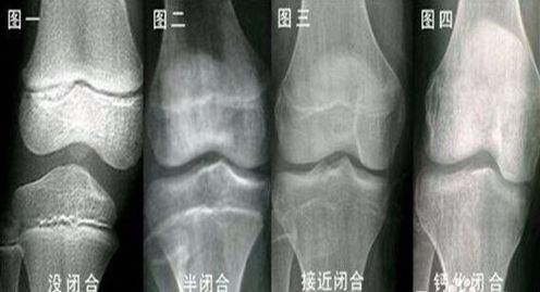 多少岁会停止长高?别瞎猜了,看完就知道!