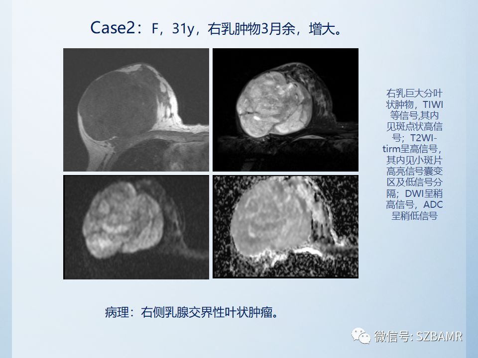 乳腺叶状肿瘤mri诊断