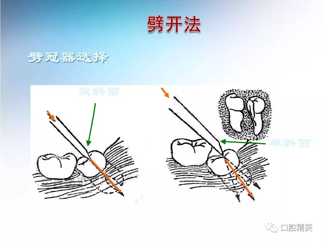 阻生齿拔除术