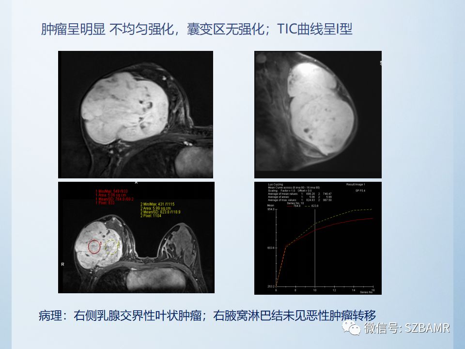 乳腺叶状肿瘤mri诊断