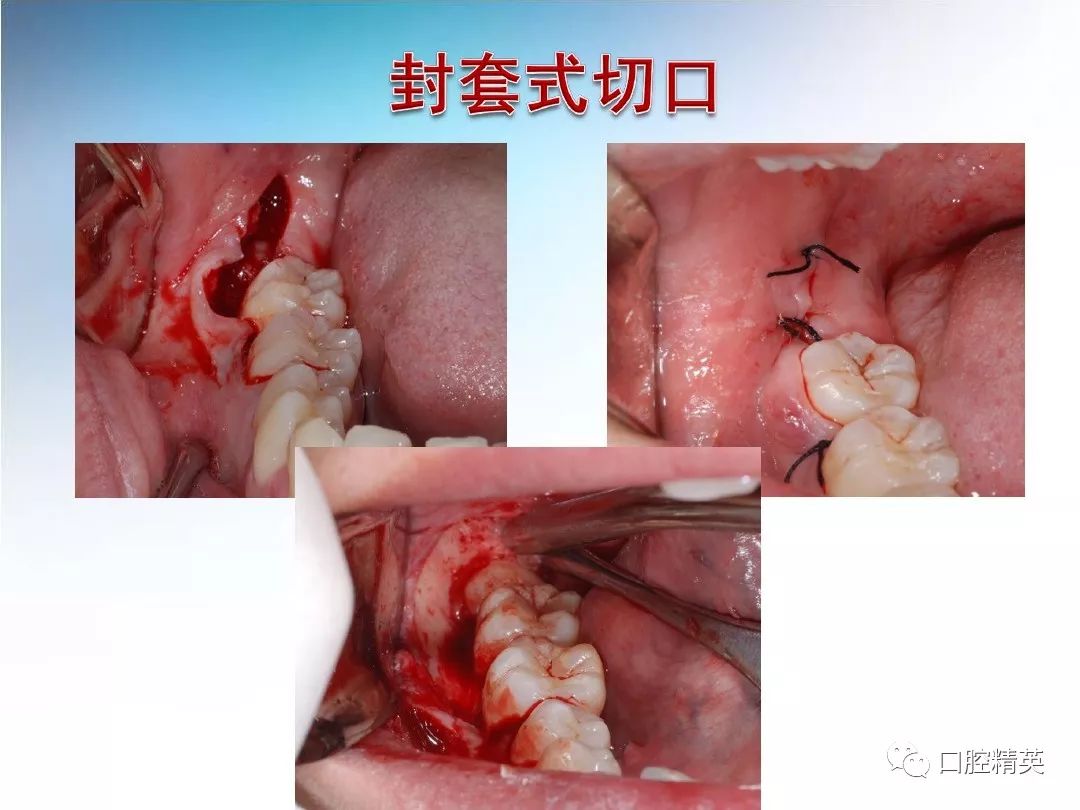 阻生齿拔除术