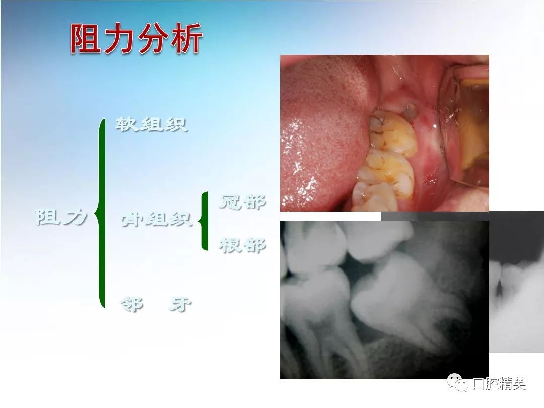 阻生齿拔除术