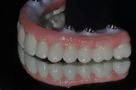 对于适应性差或者下颌义齿不稳定的患者,下颌单颗种植体固位覆盖义齿