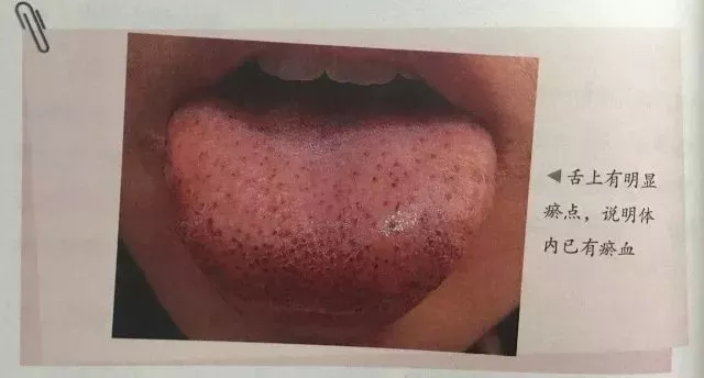 舌头上有明显的瘀点,说明体内正在形成瘀血.