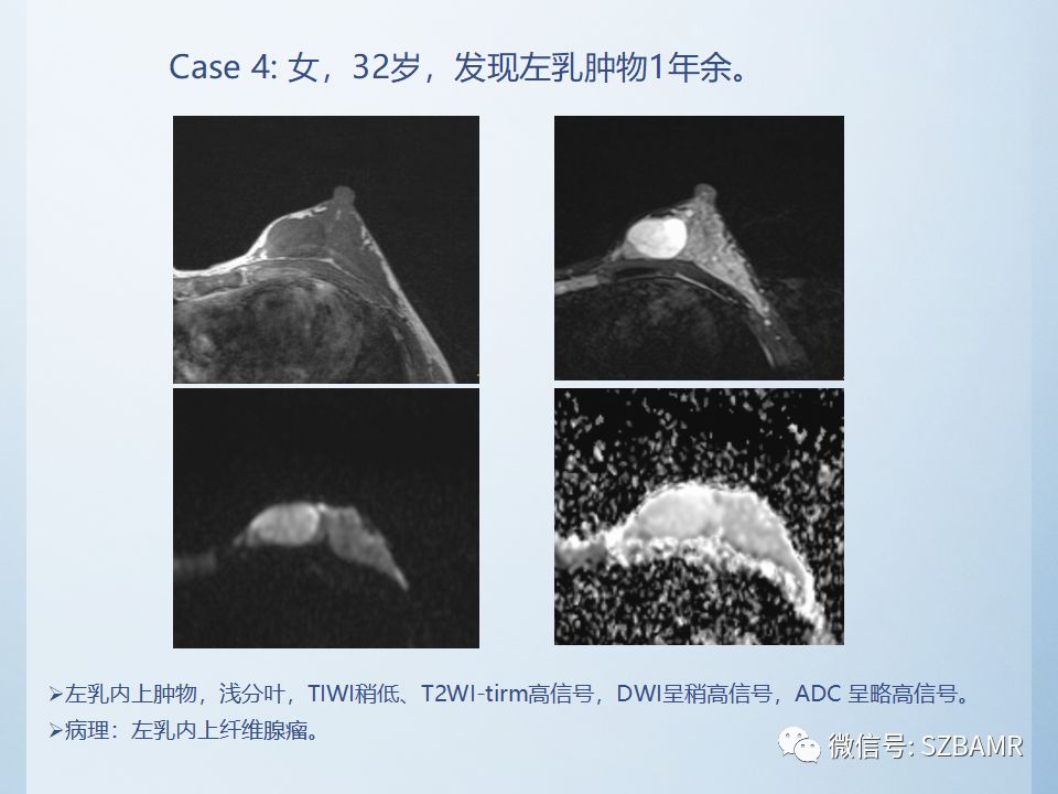 乳腺叶状肿瘤mri诊断