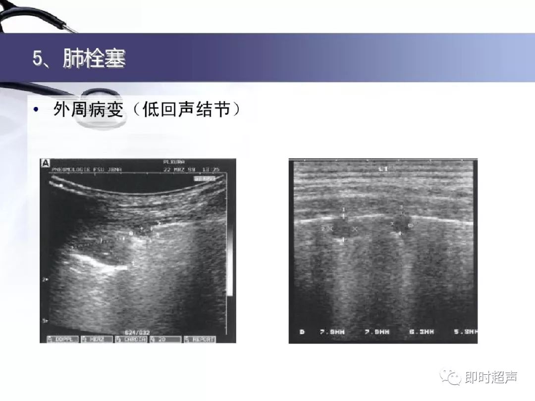 肺部超声学习笔记