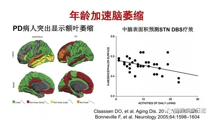 神经内科医生对pd病人dbs的全程管理