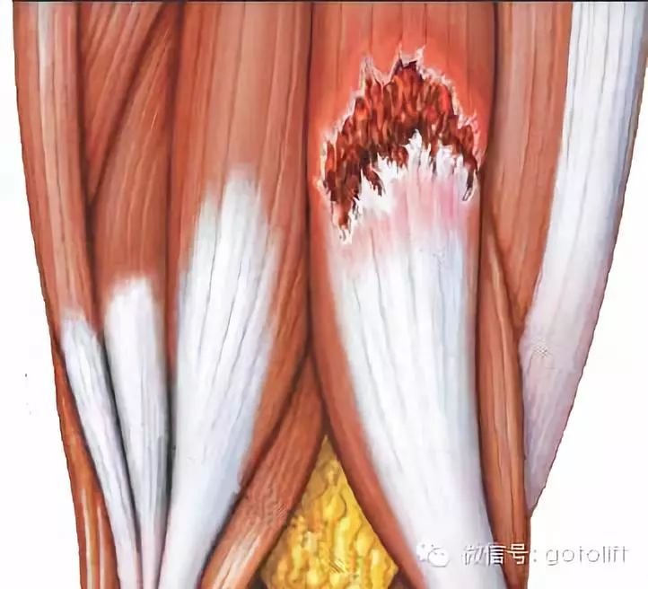 通俗的来说,肌肉拉伤就是有相当的一部分肌组织(肌肉或者肌腱,甚至