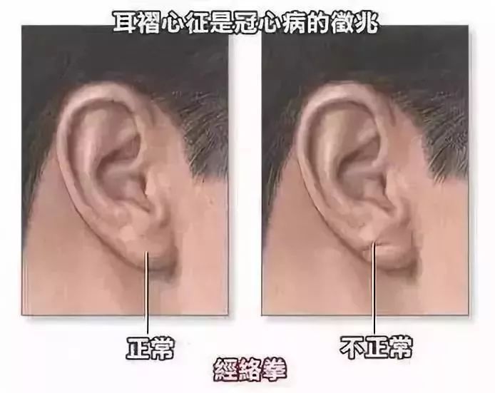 因此,耳部有褶皱的人很有可能得了冠心病,高血压,动脉硬