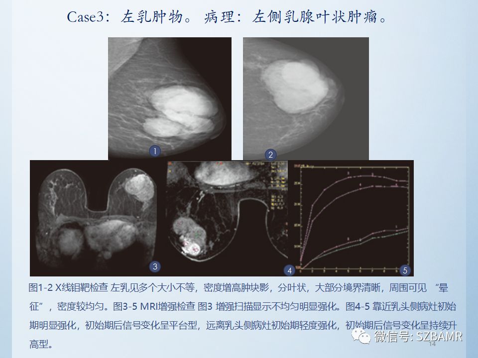 乳腺叶状肿瘤mri诊断