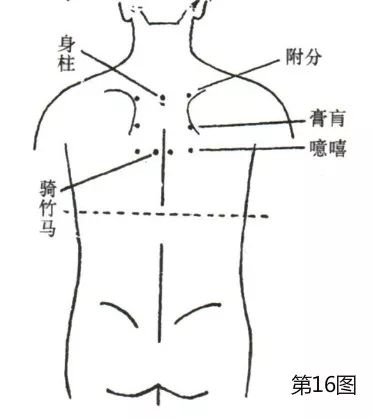 此外,还须用全体疗法(背部八穴如图,附分相当于魄户,噫嘻相当于膈关