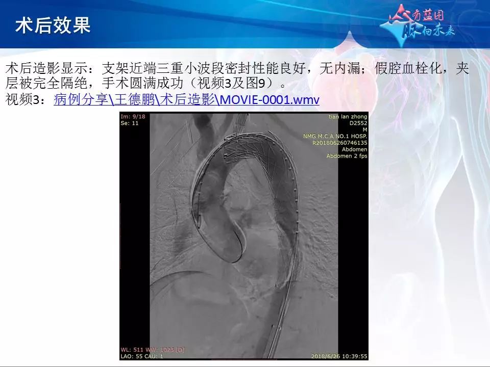 【病例分享】运用castor分支型主动脉覆膜支架系统治疗胸主动脉逆撕型