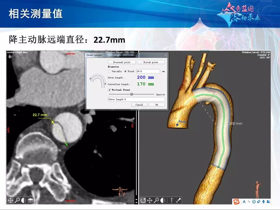 【病例分享】运用castor分支型主动脉覆膜支架系统治疗胸主动脉逆撕型