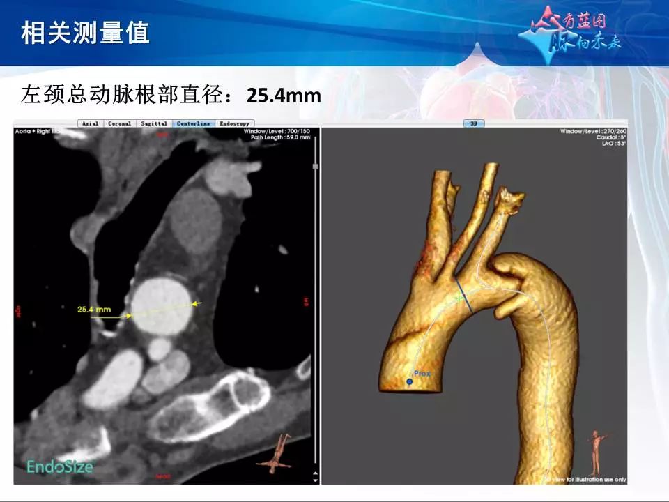 左颈总动脉根部直径:25.4mm