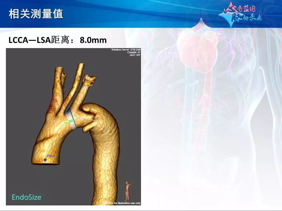 【病例分享】运用castor分支型主动脉覆膜支架系统治疗胸主动脉逆撕型