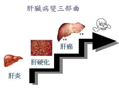 警惕肝炎来得"静悄悄" "肝炎最大危害包括急性发作致肝衰竭,死亡率