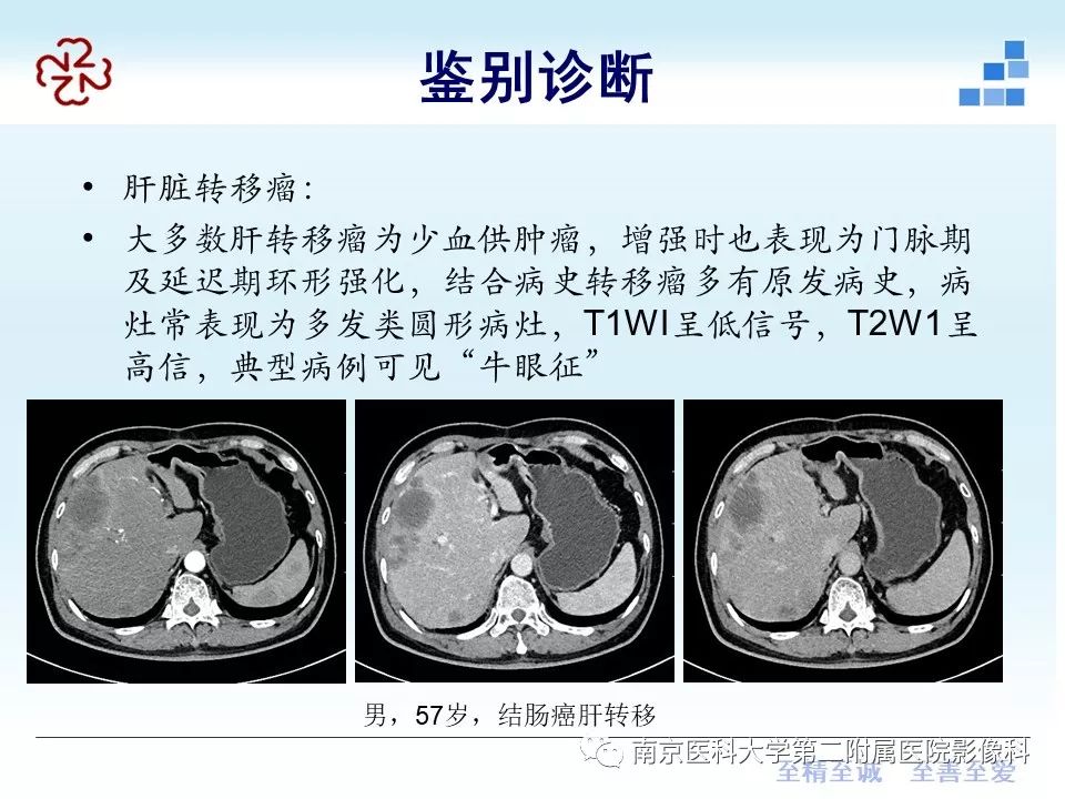 肝脏炎性假瘤的影像表现