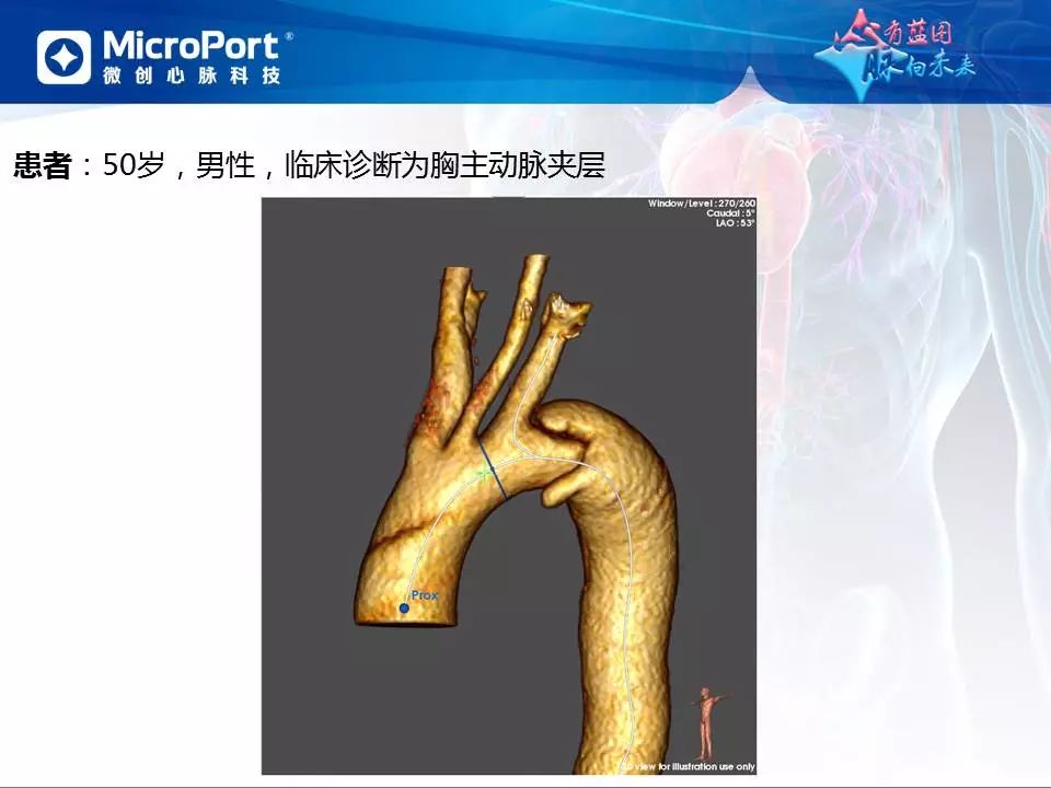 【病例分享】运用castor分支型主动脉覆膜支架系统治疗胸主动脉逆撕型