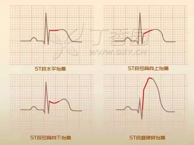 st 段上抬的时候形状更加多变,可以呈水平上抬,弓背向上抬高,弓背向下