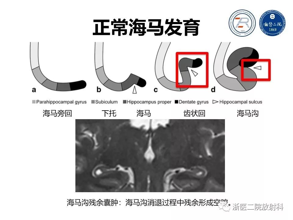 海马正常解剖及病变介绍