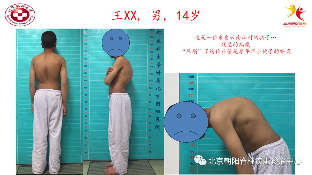 7岁小孩驼背怎么办