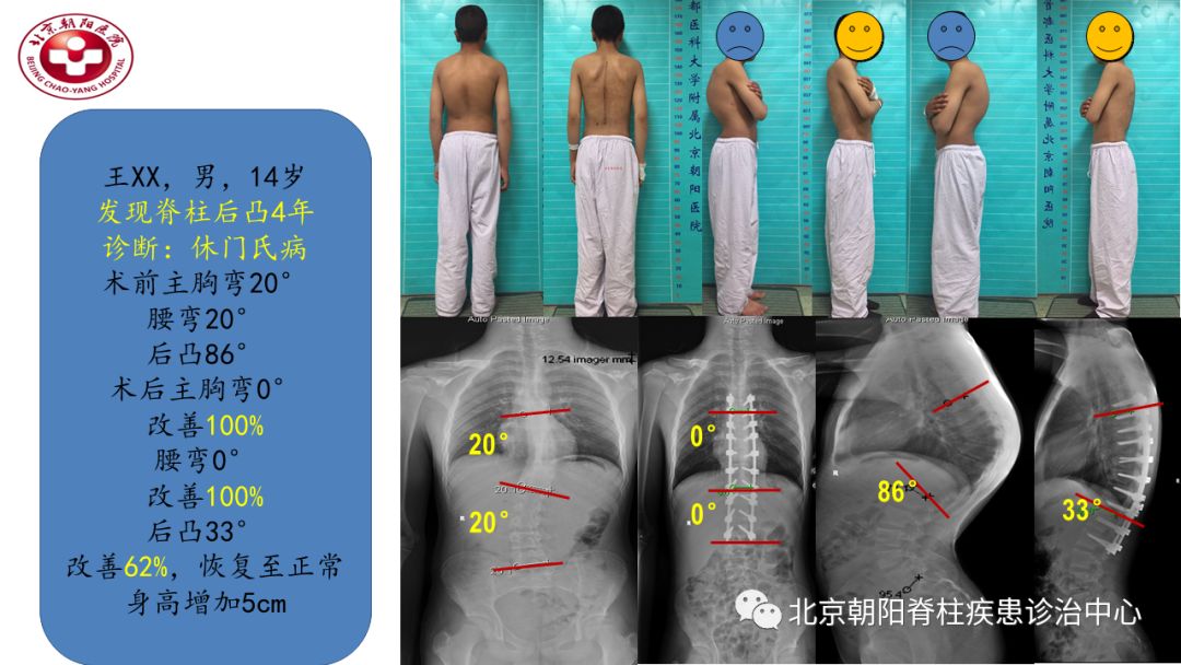 7岁小孩驼背怎么办