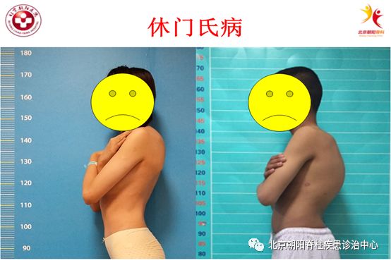 7岁小孩驼背怎么办