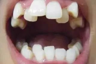 日本社会对不整齐的牙齿有较高的接纳度,有些牙齿畸形的表现也被认为