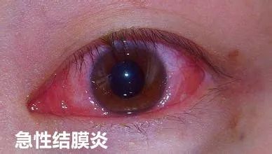 且不伴全身其他部位的出血青紫 它与另外一种"红眼病"急性结膜炎 最大