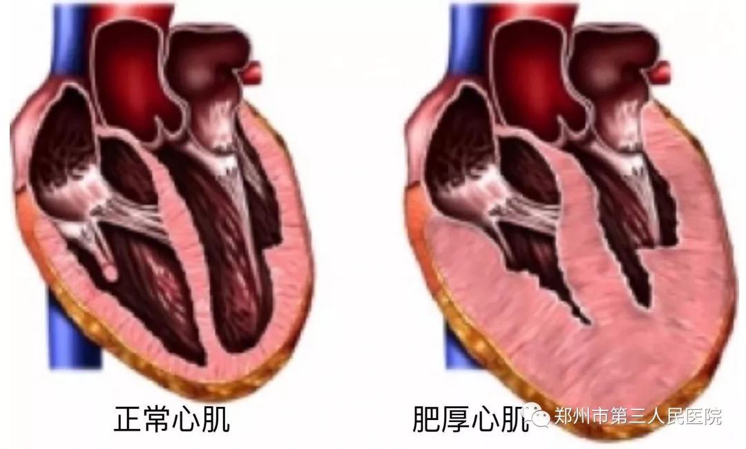 【三院·科普】心血管内科专家带您正确认识肥厚型梗阻心肌病