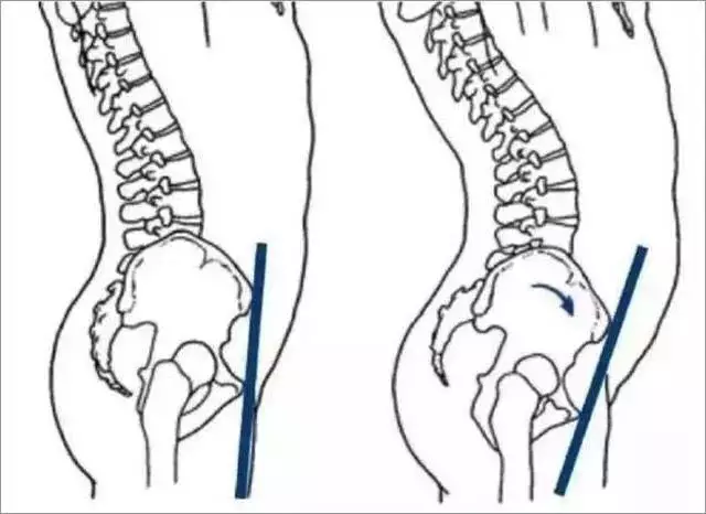 骨盆前倾幅度小不会对身体造成很大影响,但是如果 男性度数超过5